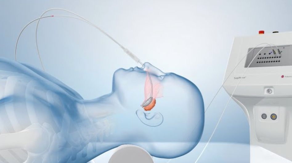 Medical illustration of a patient on a ventilator, with a breathing tube inserted through the mouth.