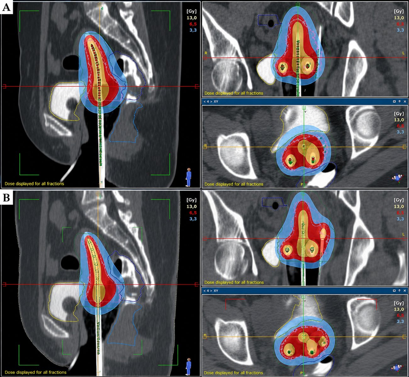 Brachytherapy